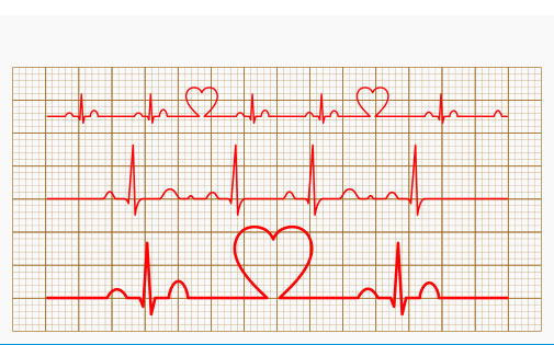 Elektrokardiyogram (EKG)